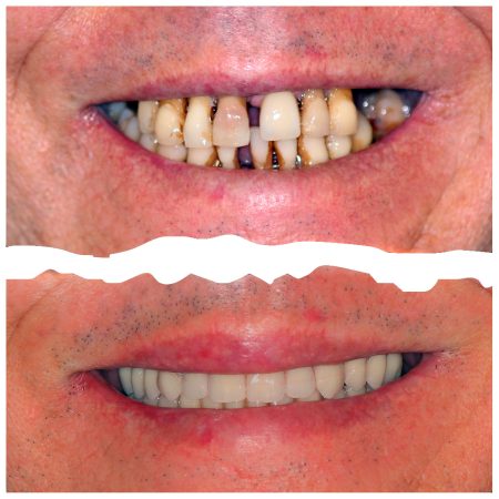 Antonio MArques Antes e Depois