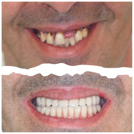 Carlos Alves Antes e Depois