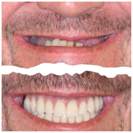 Rui Brito Antes e Depois